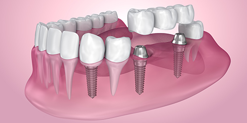 Implant dentaire Tourny